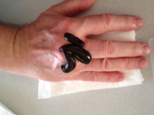 Blutegel_Hand